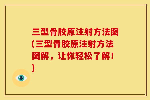 三型骨胶原注射方法图(三型骨胶原注射方法图解，让你轻松了解！)