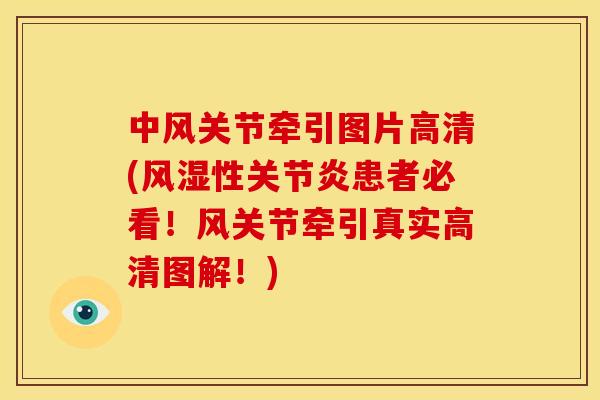 中风关节牵引图片高清(风湿性关节炎患者必看！风关节牵引真实高清图解！)
