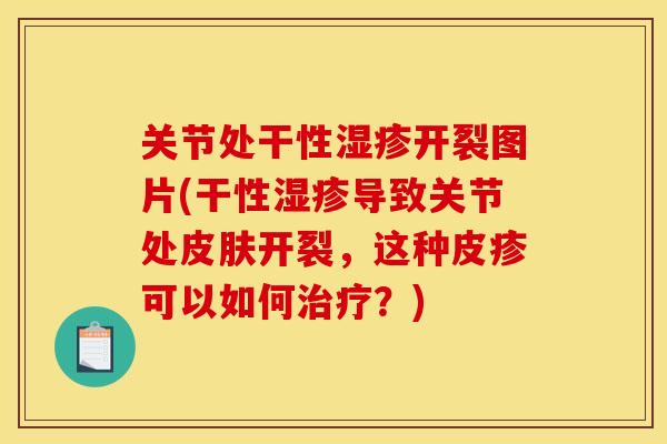 关节处干性湿疹开裂图片(干性湿疹导致关节处皮肤开裂，这种皮疹可以如何治疗？)