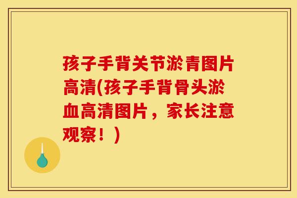 孩子手背关节淤青图片高清(孩子手背骨头淤血高清图片，家长注意观察！)