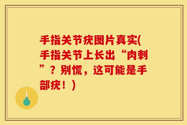 手指关节疣图片真实(手指关节上长出“肉刺”？别慌，这可能是手部疣！)