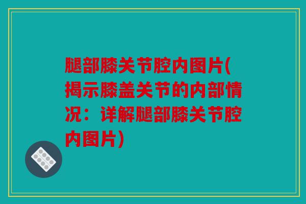 腿部膝关节腔内图片(揭示膝盖关节的内部情况：详解腿部膝关节腔内图片)